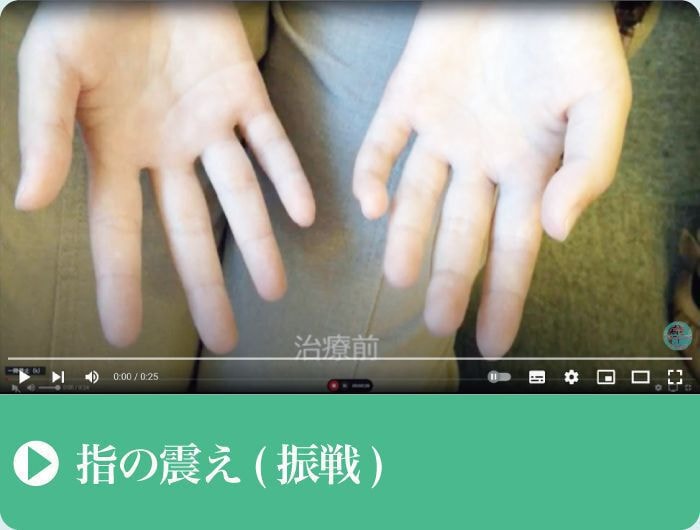 施術前と施術後｜指の震え｜振戦｜ファミリーカイロプラクティックセンター福岡